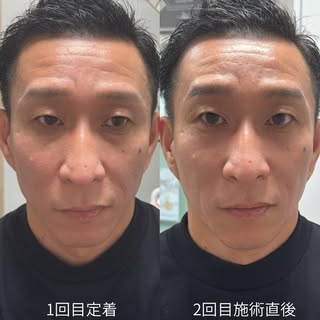 眉が変わると、第一印象が変わる。

男性のアートメイクは、
「眉を描いた感じ」を出すためではなく、
その人が本来持っている魅力を自然に引き出すためのもの。

1回目の定着から、さらにバランスを見ながら