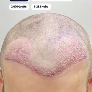 Hairline restoration - 2,379 grafts, 6,410 hairs, planned and designed before a single follicle was 