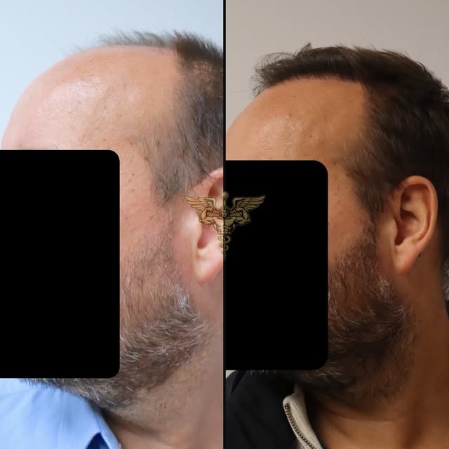 6 month update!

Natural and conservative was this patient’s preference.
Hair is personal and requir