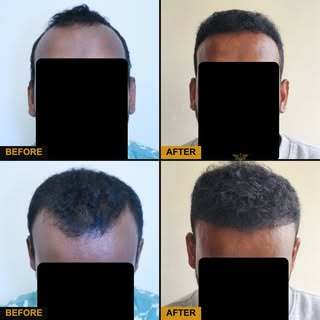 6 month update!

🌱 Grafts: 2662
  
🔗 Recipient zones:  Frontotemporal, Crown regions 
  
📍 Auckla