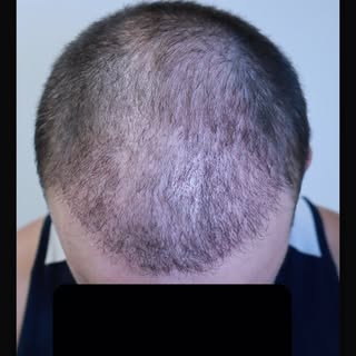 Sneaky 6 month update from one of my Auckland, New Zealand patients.

Definitely ahead of the curve 