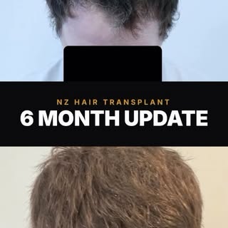 6 months post hair transplant surgery.

Typically you can expect 50% of your results at this stage i