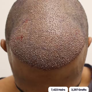3,297 grafts. 7,423 hairs. Placed to build density, not to move the hairline.

Sometimes the goal is