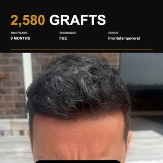 .

6 MONTHS POST OP
====================

Graft quality is important but SO is follicular density. W