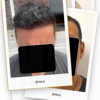 6month update 

Little sneak peak at the halfway point! Patient is stoked and I’m still working on m
