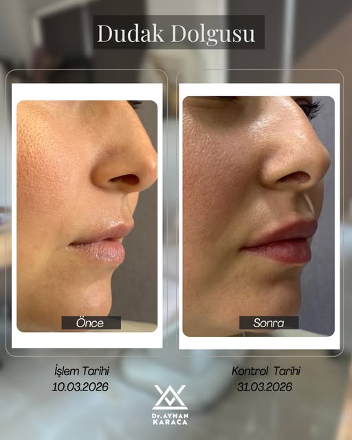 Karşıdan baktık… Peki ya yan profilden? 👀👄

Dudak dolgusunda değişim yalnızca önden değerlendirilm