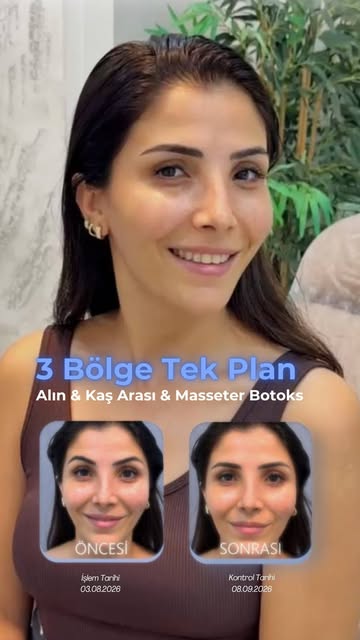 Küçük dokunuşlar, kontrollü bir süreç, doğallığı koruyan bir plan. ✨🤩

Alın, kaş arası ve masseter 