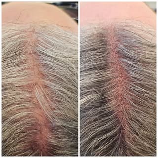 What is SMP? 🤔

Scalp Micro Pigmentation is the application of small tattooed dots to replicate the
