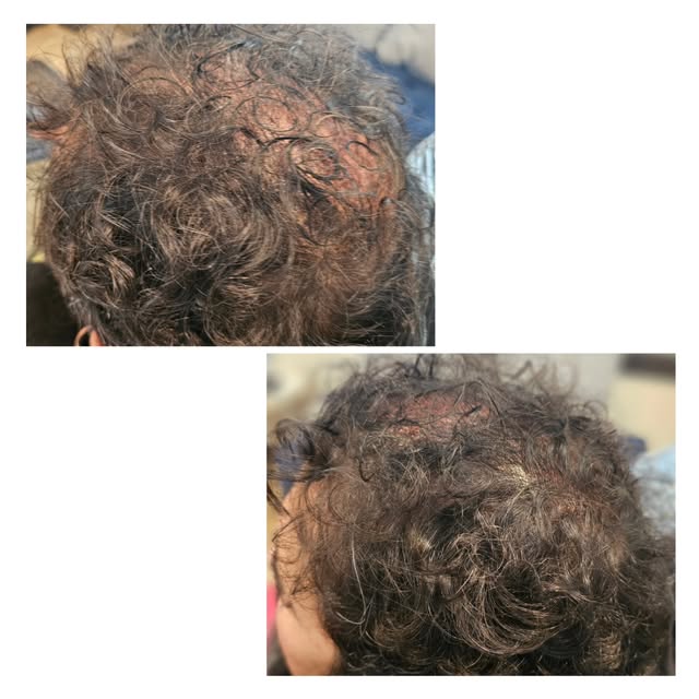 Are you curious about Scalp Micro Pigmentation or SMP? This cosmetic tattoo service uses small dots 