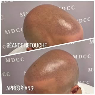 #tricopigmentation #micropigmentation #barbershop #var #toulon
