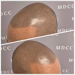 Retouche annuelle pour rayonner avec son traitement!
#micropigmentation #tricopigmentation #tattoo #