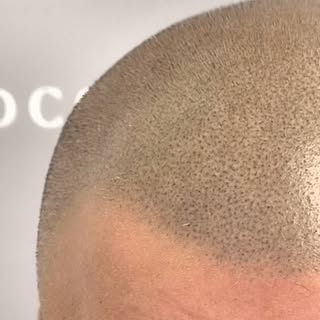 ZOOM SUR UNE SÉANCE RETOUCHE APRÈS 2 ANS

#micropigmentation #tricopigmentation #toulon #nice #marse