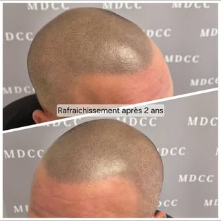 Entretenir sa micropigmentation capillaire pour un rendu tout aussi frais qu'au premier jour 😉

#mi