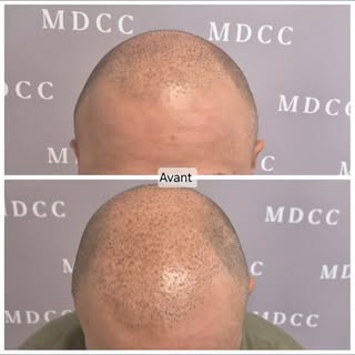 Passer à l'acte pour un look plus soigné...

#micropigmentation #tricopigmentation #tattoo #toulon #