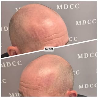 Quelle belle transformation!! AVANT/APRÈS 

#micropigmentation #tricopigmentation #cheveux #look #ta