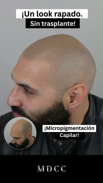 ¿Entradas? ¿Calvicie? ¿Poco volumen?

¡Dale un nuevo look a tu imagen!

Con la micropigmentación cap
