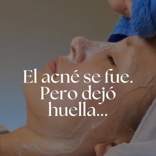 El acné se fue. Pero dejó huella. 🔍
Las cicatrices post-acné son una de las consultas más frecuente