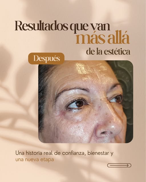 ✨ Resultados que van más allá de la estética.

Hoy compartimos el antes y el después de una paciente