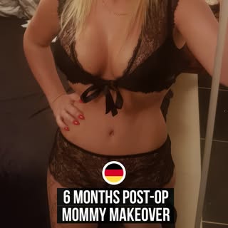 6 months post-op and the transformation speaks for itself ✨
Every journey is unique, and this beauti