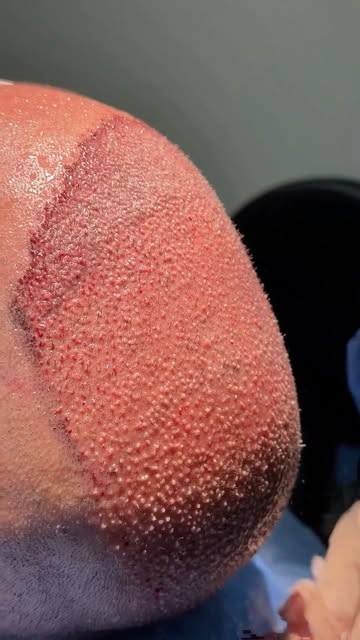 Recuperar os cabelos pode ser o começo de uma nova relação com a própria imagem.

Dr. Gabriel dos Sa