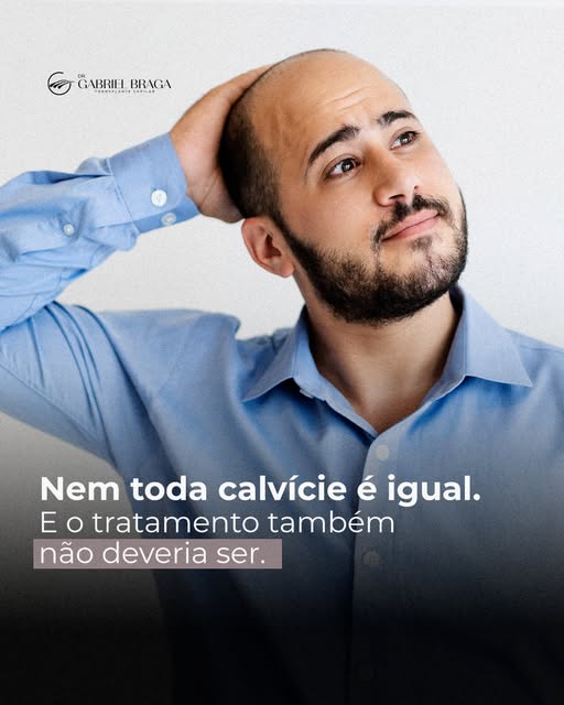 A calvície não evolui da mesma forma para todas as pessoas. Existem diferentes graus de alopecia, qu
