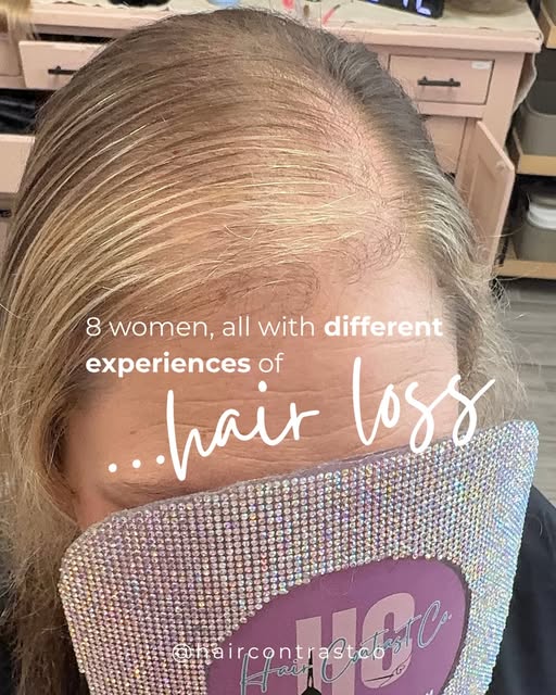 Hair loss doesn’t look the same for everyone. And neither does the experience of living with it.

Fo