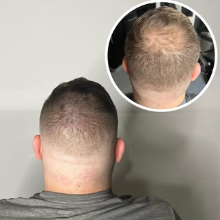 I have the Perfect Hairloss solution 
-Scalp Micropigmentation 

This is a Density Treatment in the 