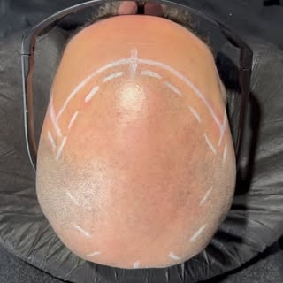 Stop struggling with Hair loss!
Swipe to see results…
Let’s get you back in the Game.

Dm for more i