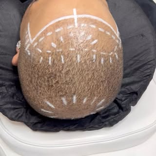 1 sessions of Scalp Micropigmentation 

Guaranteed results in your first session 

If you would like