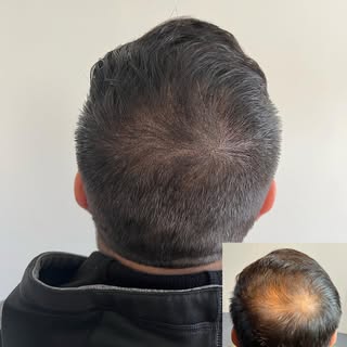 This is a Density Treatment in crown area- this helps reduce the thinning look
Giving you a more att