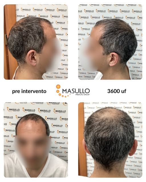 Scorri il carosello per scoprire il percorso e la trasformazione di questo nostro paziente, dopo 9 m