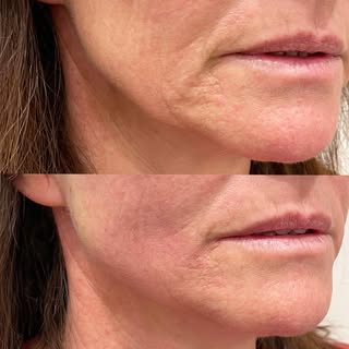 Facial thread lift