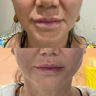 Facial thread lift