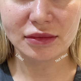 Facial thread lift