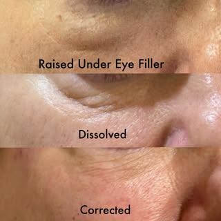 Old Under eye filler correction