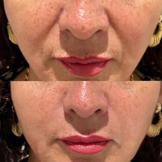 Smile line filler