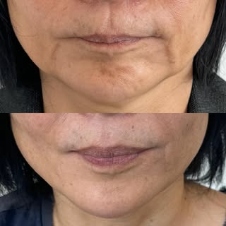 Facial thread lift