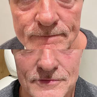Cheeks & under eye filler