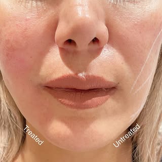 Facial thread lift
