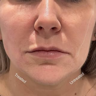Facial thread lift