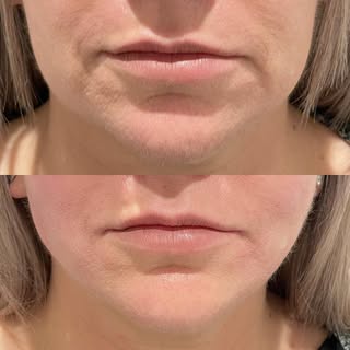 Facial thread lift