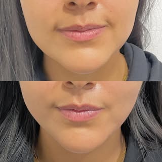 Facial thread lift
