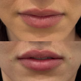 Natural looking lips
Cannula technique

@cosmomedclinics