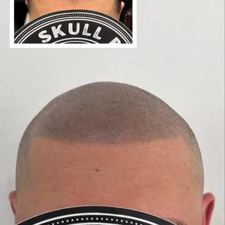 LOOKING FOR HAIRLOSS SOLUTION?

* SMP is a non-invasive treatment that does not require any surgical