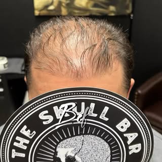 LOOKING FOR HAIRLOSS SOLUTION?

* SMP is a non-invasive treatment that does not require any surgical