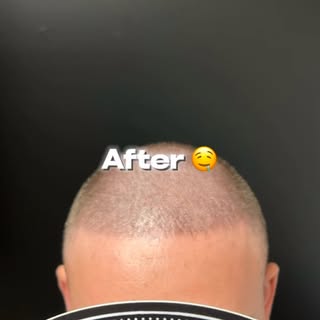 LOOKING FOR HAIRLOSS SOLUTION?

* SMP is a non-invasive treatment that does not require any surgical