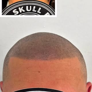 LOOKING FOR HAIRLOSS SOLUTION?

* SMP is a non-invasive treatment that does not require any surgical