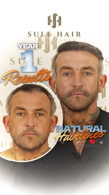 Discover all the details behind the remarkable transformation and natural frontal hairline of our pa