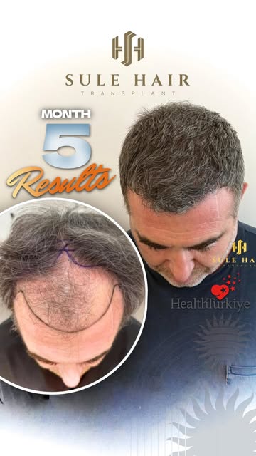 ✨ An amazing transformation in just 5 months!

Our patient traveled from Switzerland and chose Sule 