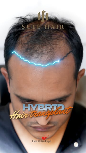 Naturalness and density combined with the Hybrid Hair Transplant Technique. 🧬
Single grafts are str